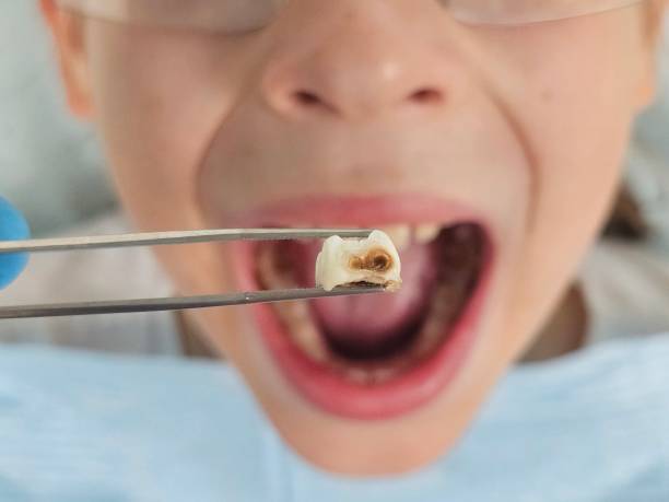 Best Urgent Tooth Repair  in Breckenridge, MN